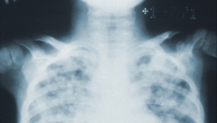 Новости  - 40% больных коронавирусом в России не имеют симптомов