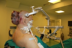 Новости  - С затылка казанца удалили опухоль размером с голову (18+)